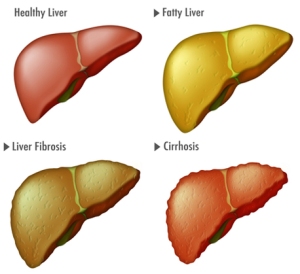 penyakit liver bengkak